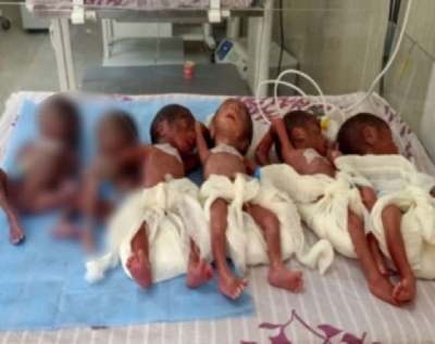 இலங்கையில் முதன்முறையாக Sextuplets !